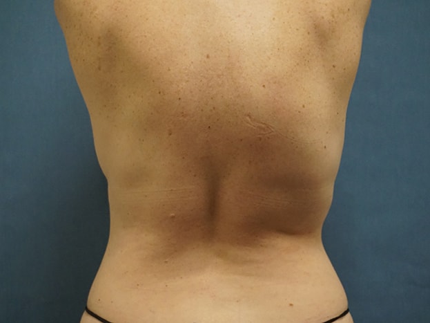 Herte Center for Cosmetic Surgery liposuction after — Las Vegas, NV