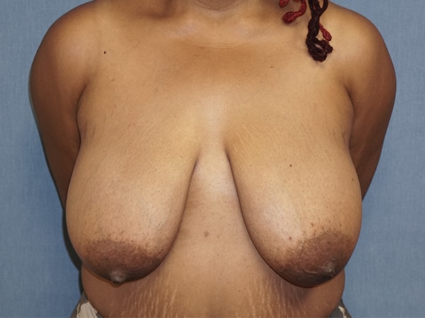 Breast Reduction before photo