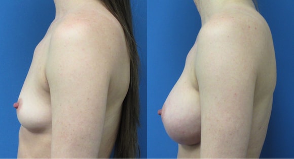 A result from Denver Plastic Surgery and Aesthetics