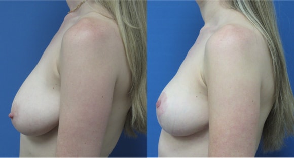 A result from Denver Plastic Surgery and Aesthetics