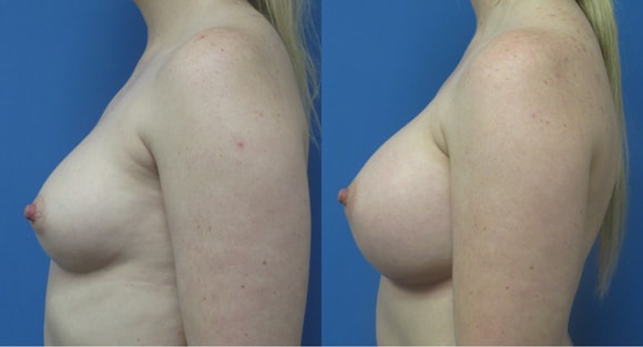 A result from Denver Plastic Surgery and Aesthetics