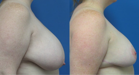 A result from Denver Plastic Surgery and Aesthetics