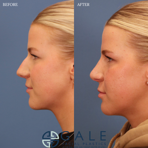 Rhinoplasty result at Gale Facial Plastics