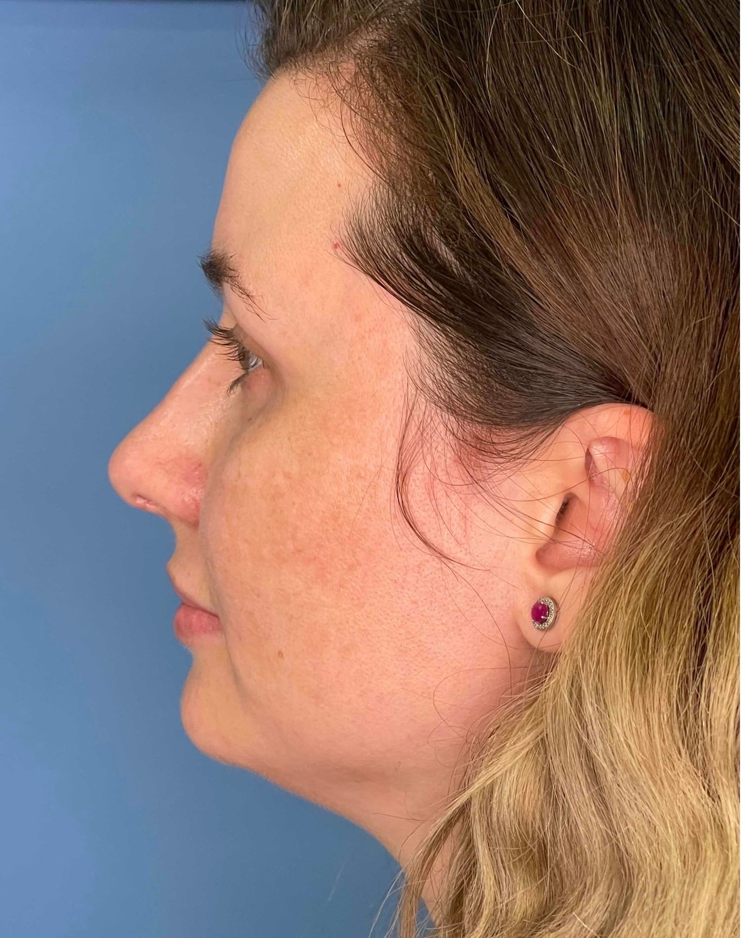 A result from Dr. Ali Plastic Surgery & Amae Medspa