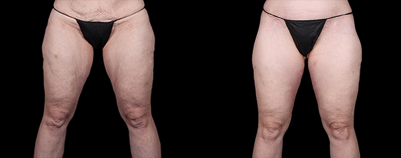 A result from Avante Plastic Surgery