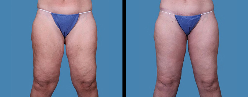 A result from Avante Plastic Surgery
