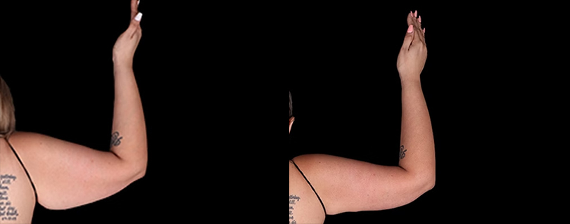 A result from Avante Plastic Surgery