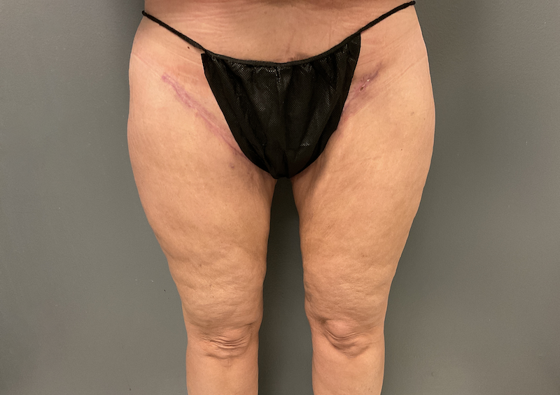 A result from DeLozier Plastic Surgery