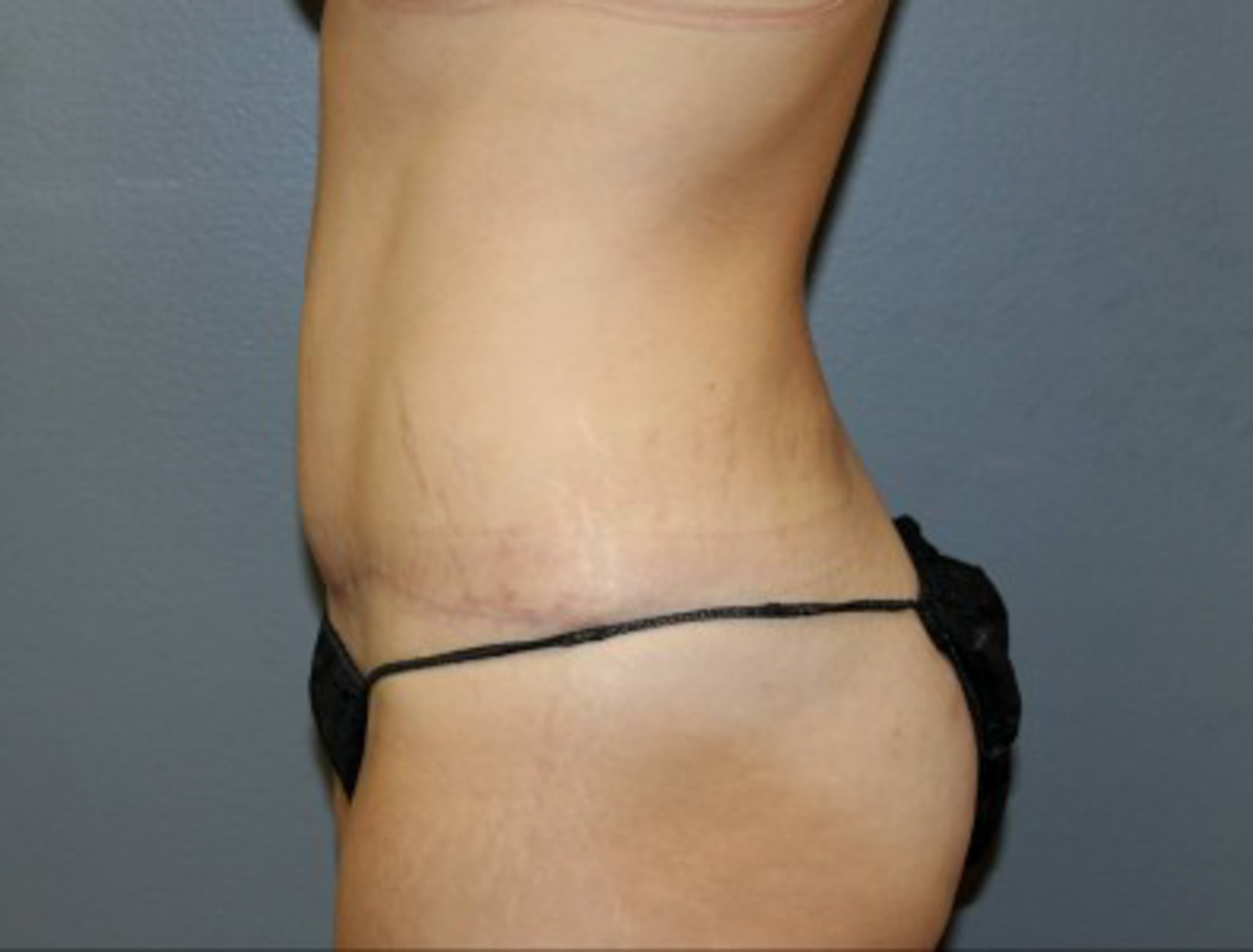 A result from DeLozier Plastic Surgery