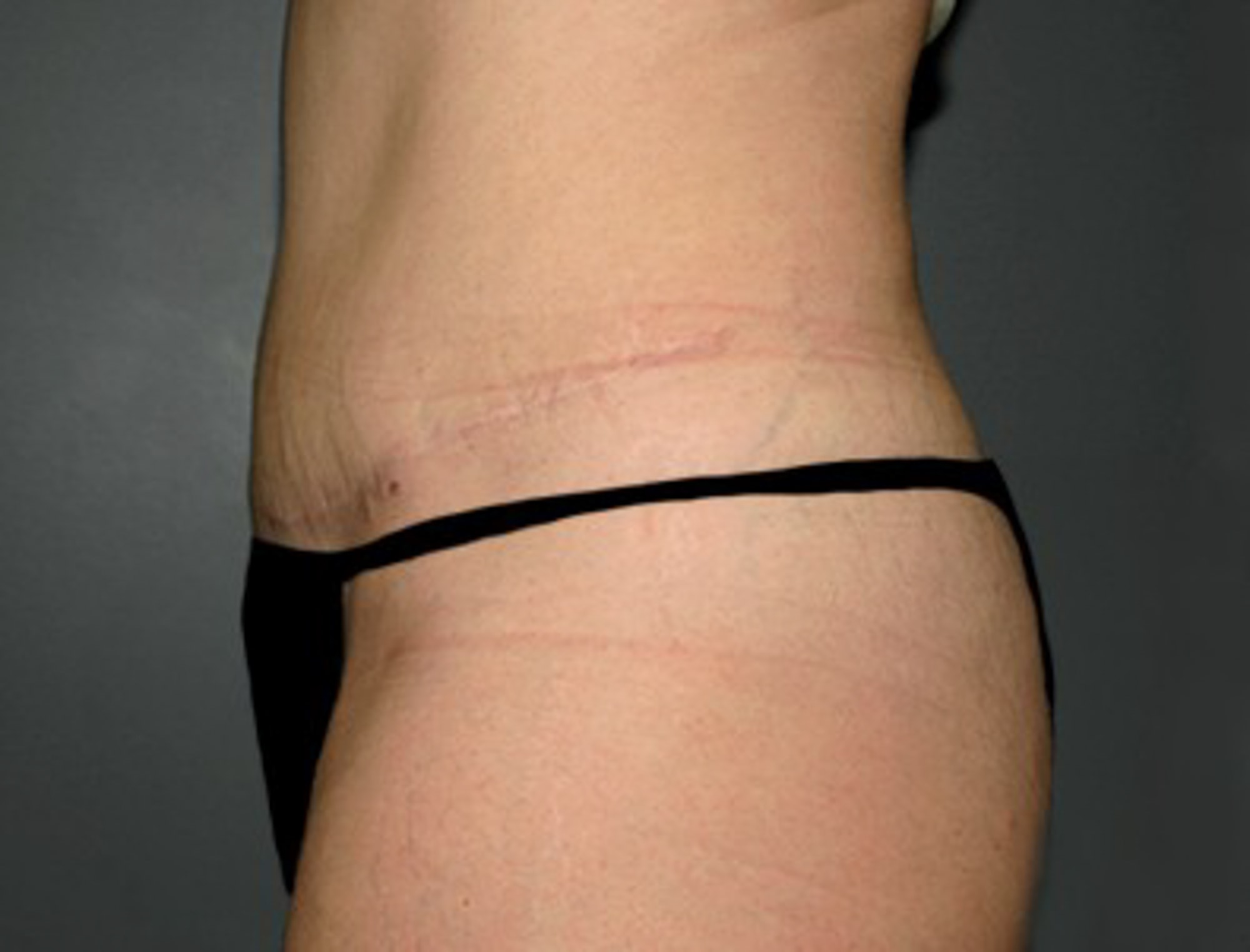 A result from DeLozier Plastic Surgery
