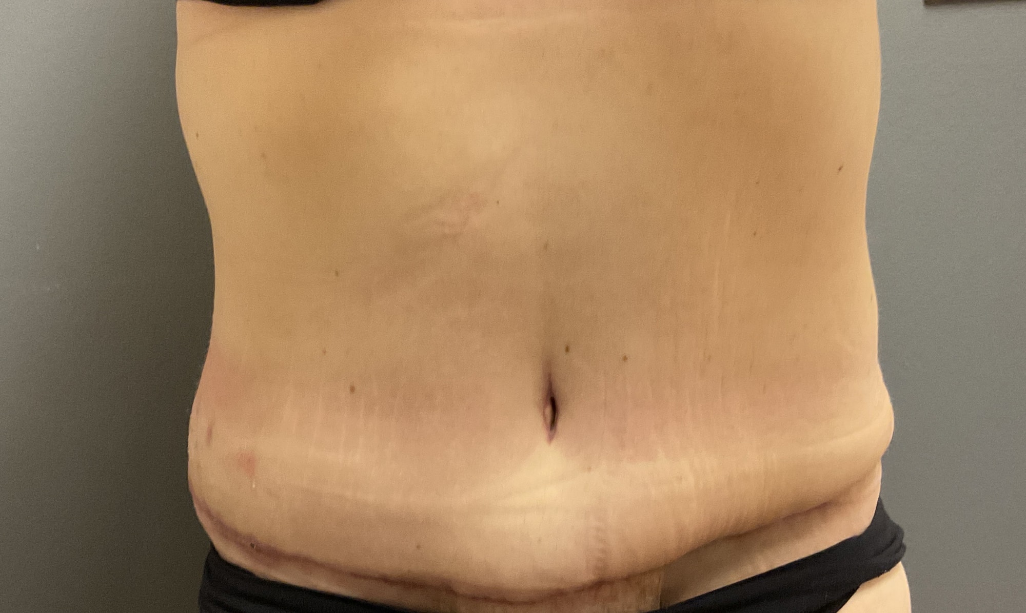 A result from DeLozier Plastic Surgery