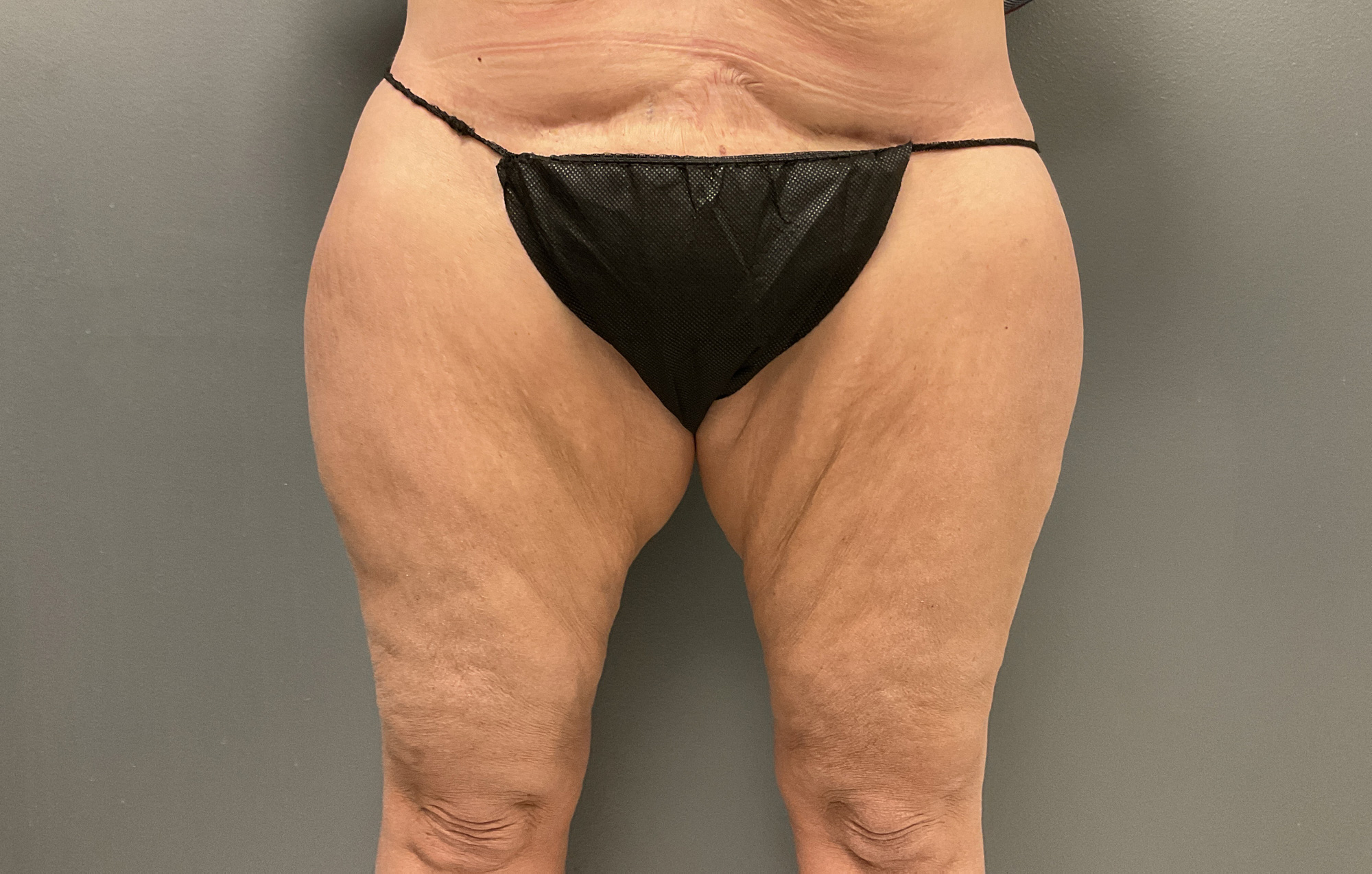 A result from DeLozier Plastic Surgery