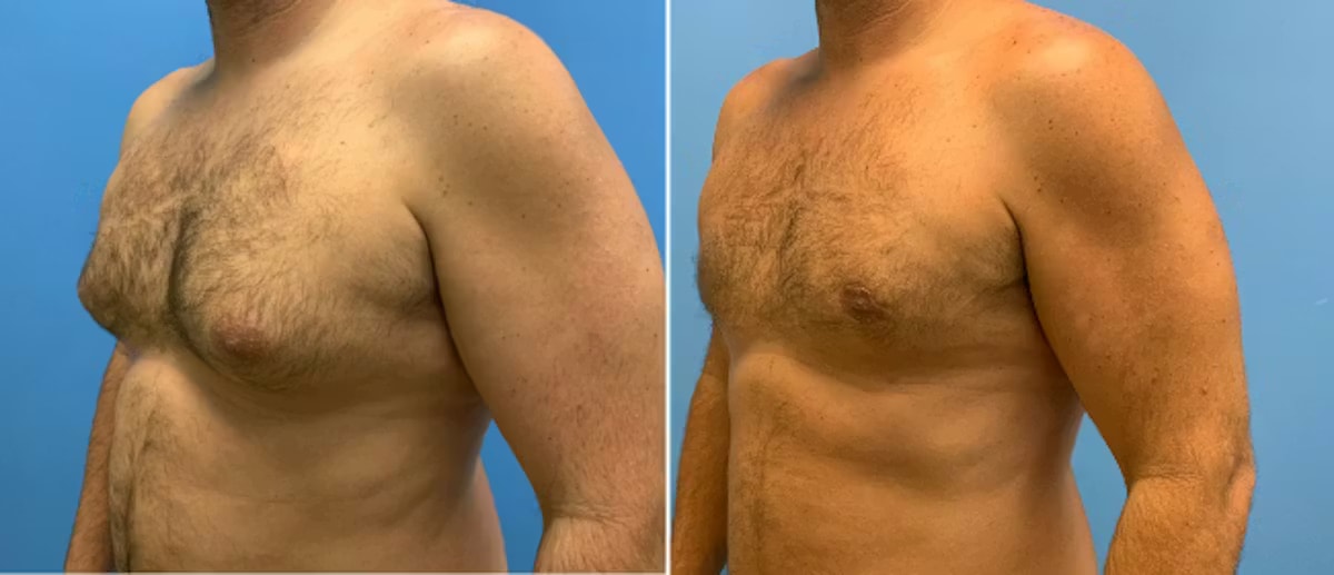 A result from CosmetiCare Plastic Surgery Newport Beach & Med Spa