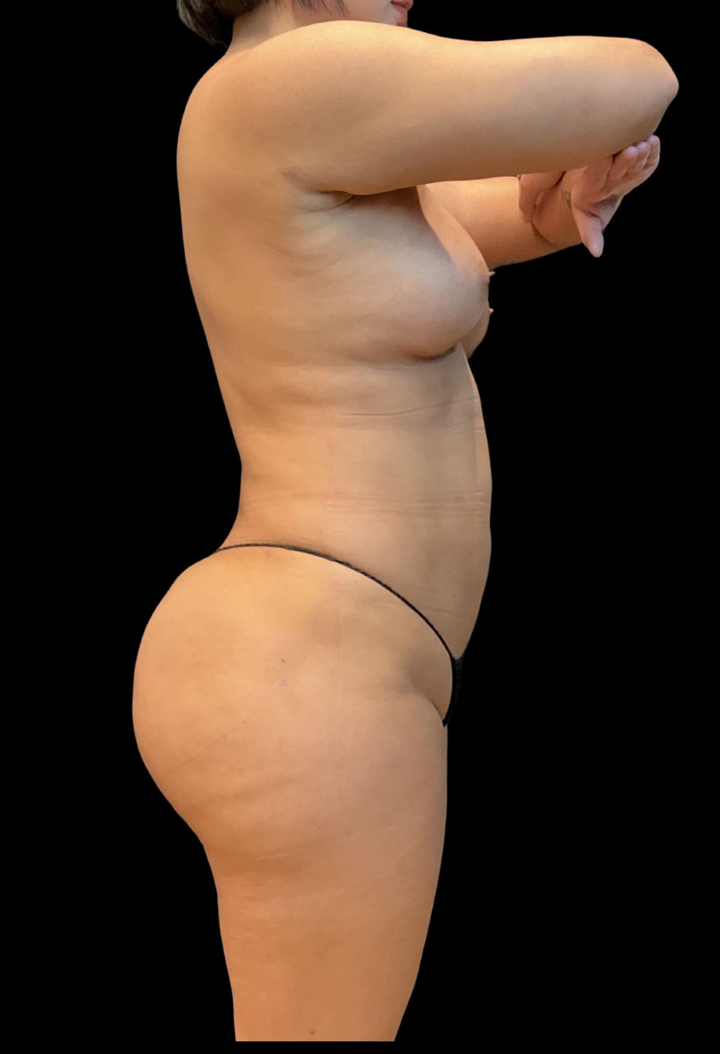 A result from Austin Plastic Surgeon