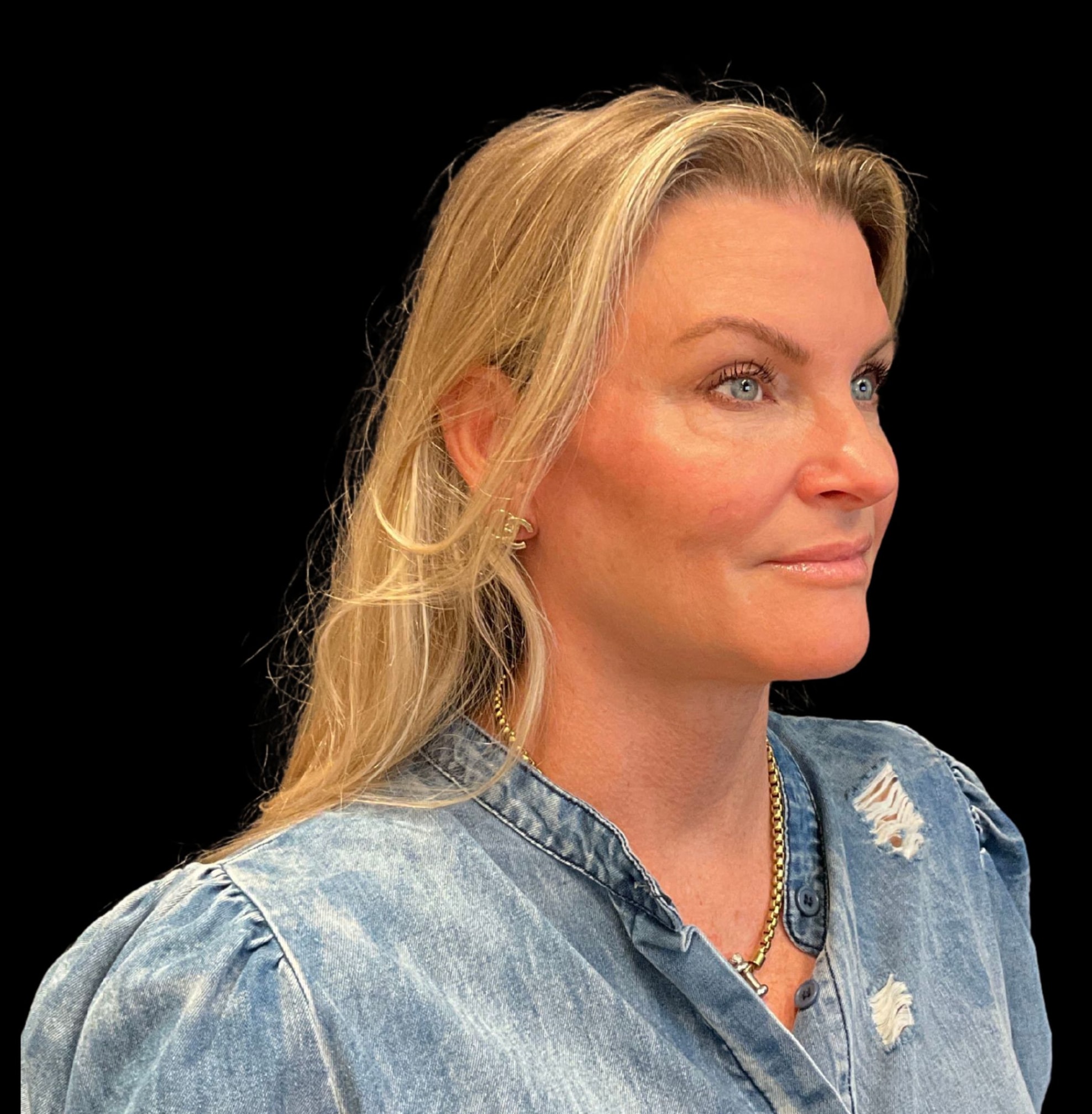 A result from Austin Plastic Surgeon
