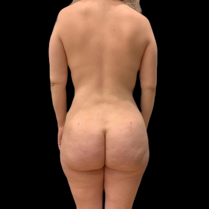 A result from Austin Plastic Surgeon