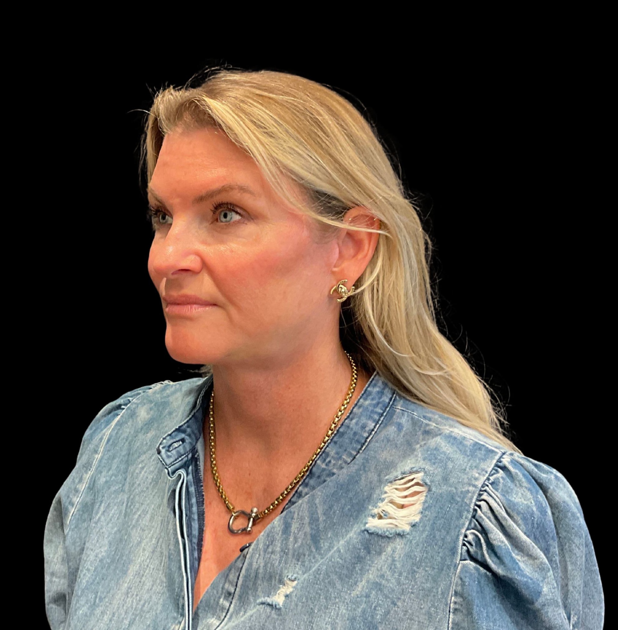 A result from Austin Plastic Surgeon