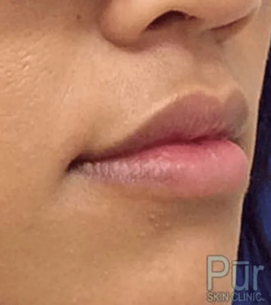 A result from Pūr Skin Clinic - Seattle