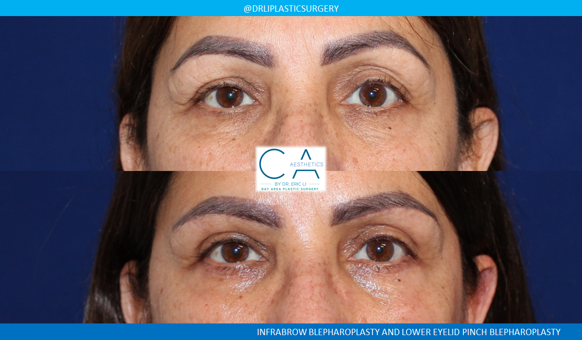 A result from CA Aesthetics: Bay Area Plastic Surgery Eric Li, MD
