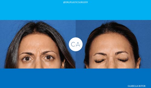 A result from CA Aesthetics: Bay Area Plastic Surgery Eric Li, MD