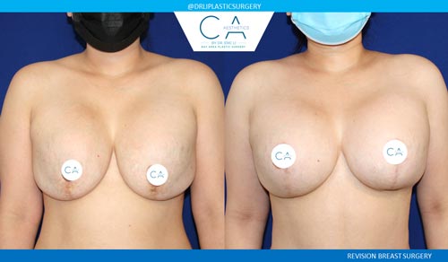 A result from CA Aesthetics: Bay Area Plastic Surgery Eric Li, MD