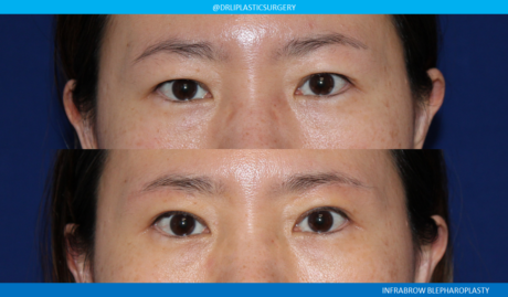 A result from CA Aesthetics: Bay Area Plastic Surgery Eric Li, MD