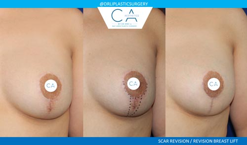A result from CA Aesthetics: Bay Area Plastic Surgery Eric Li, MD