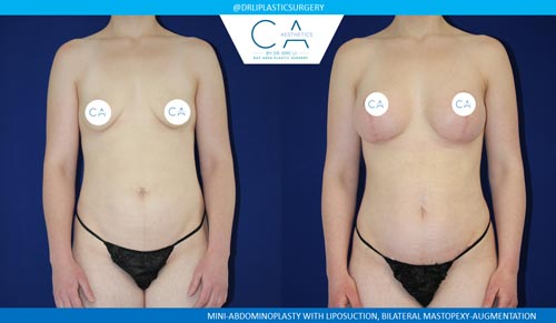 A result from CA Aesthetics: Bay Area Plastic Surgery Eric Li, MD