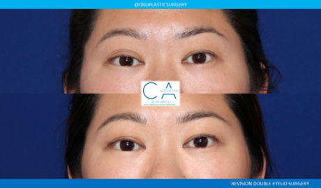 A result from CA Aesthetics: Bay Area Plastic Surgery Eric Li, MD
