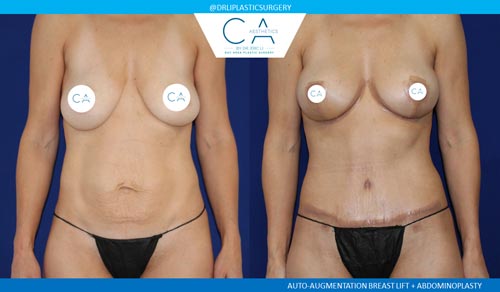 A result from CA Aesthetics: Bay Area Plastic Surgery Eric Li, MD