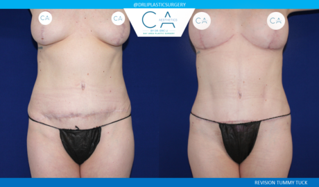 A result from CA Aesthetics: Bay Area Plastic Surgery Eric Li, MD