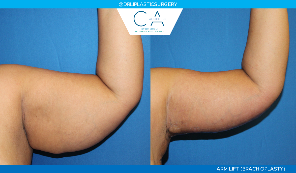 A result from CA Aesthetics: Bay Area Plastic Surgery Eric Li, MD