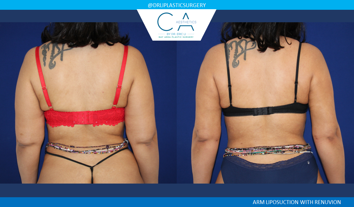 A result from CA Aesthetics: Bay Area Plastic Surgery Eric Li, MD