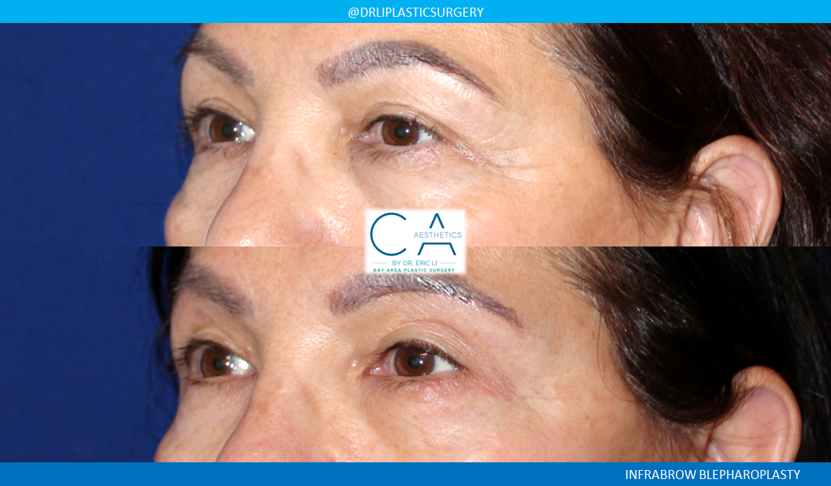 A result from CA Aesthetics: Bay Area Plastic Surgery Eric Li, MD