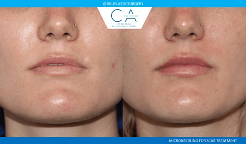 A result from CA Aesthetics: Bay Area Plastic Surgery Eric Li, MD