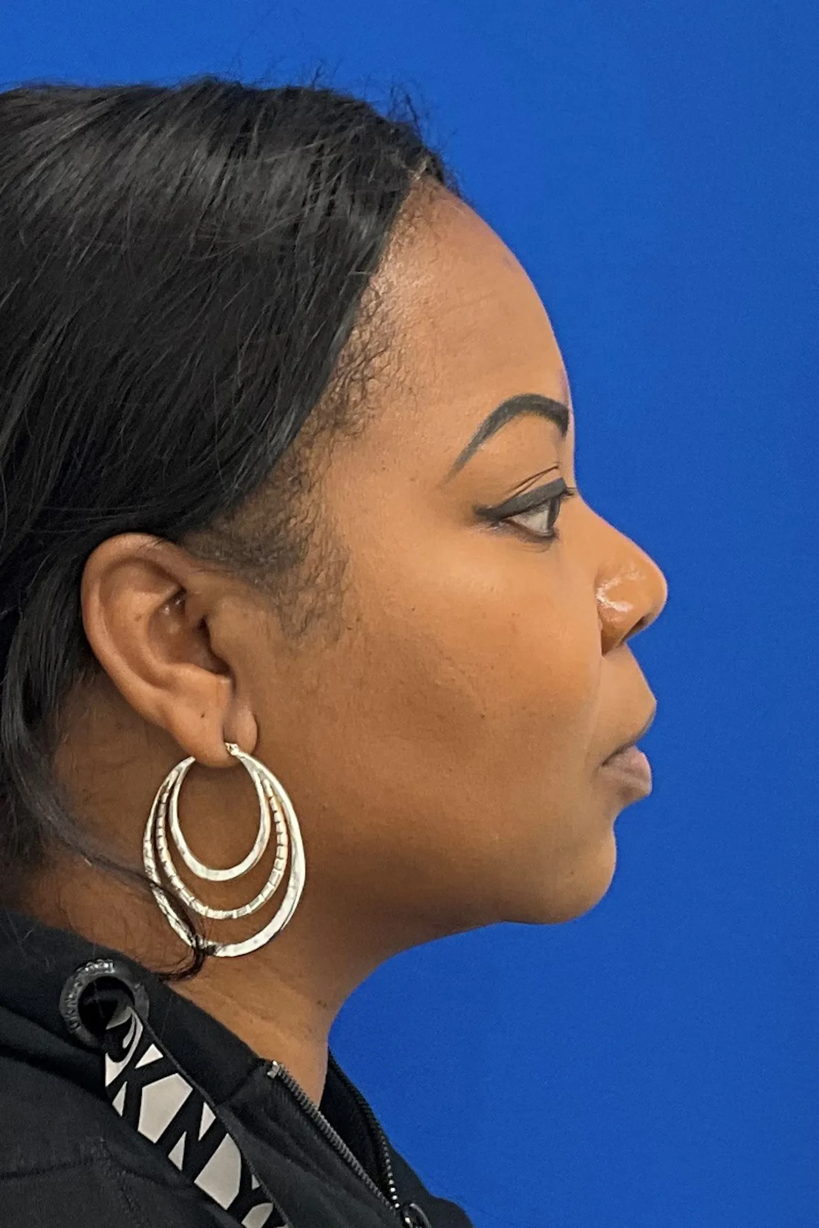A result from Palm Beach Plastic Surgery Institute