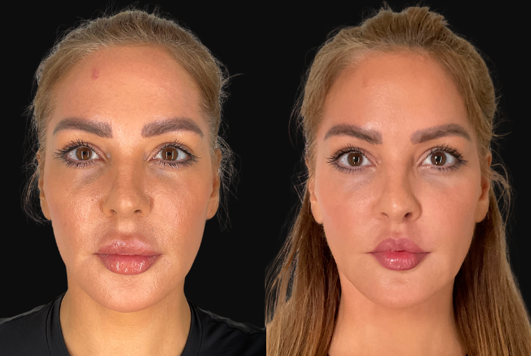 Procedure result at Ourian Plastic Surgery
