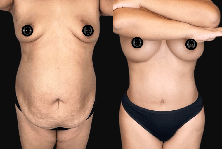 Mommy Makeover result at Ourian Plastic Surgery