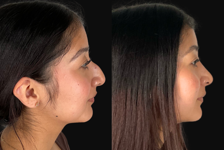 Procedure result at Ourian Plastic Surgery