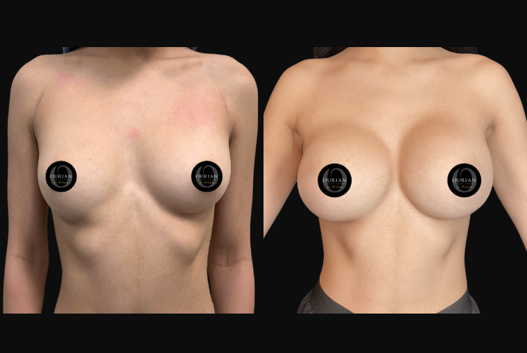 Breast Augmentation result at Ourian Plastic Surgery