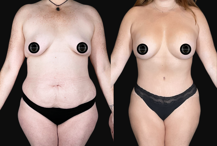 Mommy Makeover result at Ourian Plastic Surgery