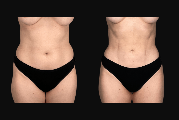 Liposuction result at Ourian Plastic Surgery