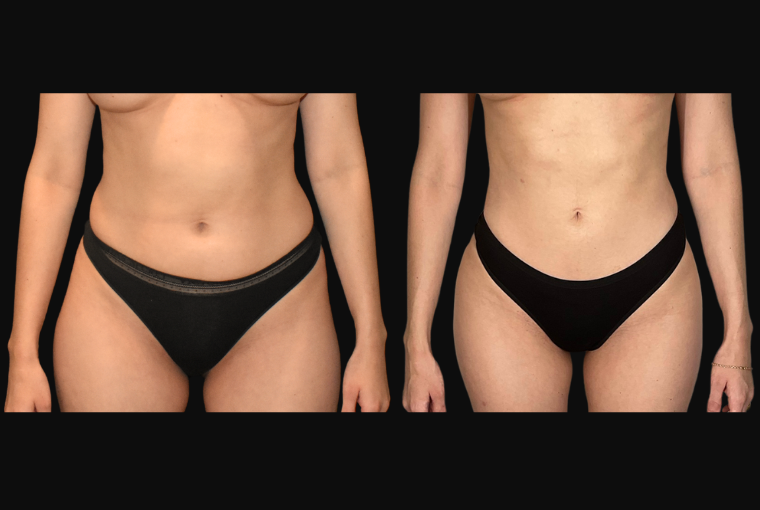 Body Contouring result at Ourian Plastic Surgery