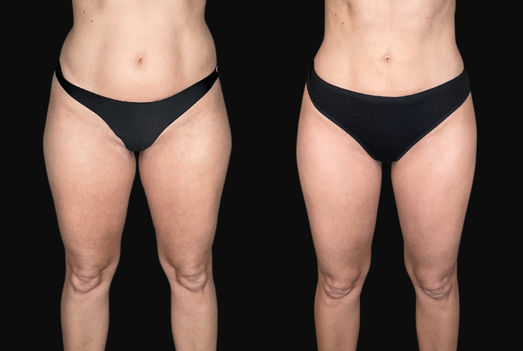 Liposuction result at Ourian Plastic Surgery