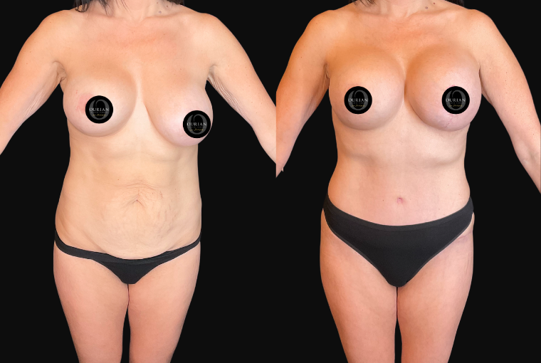 Body Contouring result at Ourian Plastic Surgery