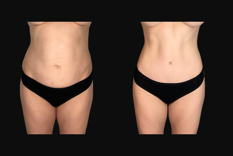 Body Contouring result at Ourian Plastic Surgery