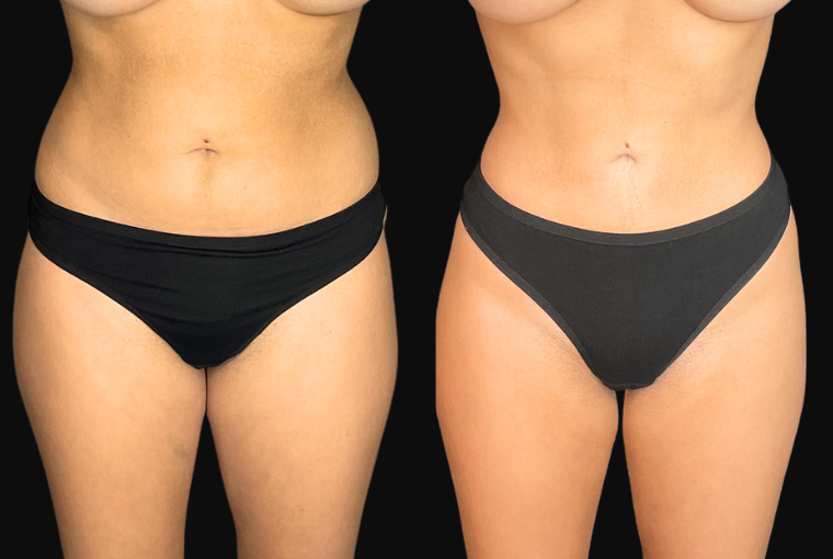 Body Contouring result at Ourian Plastic Surgery