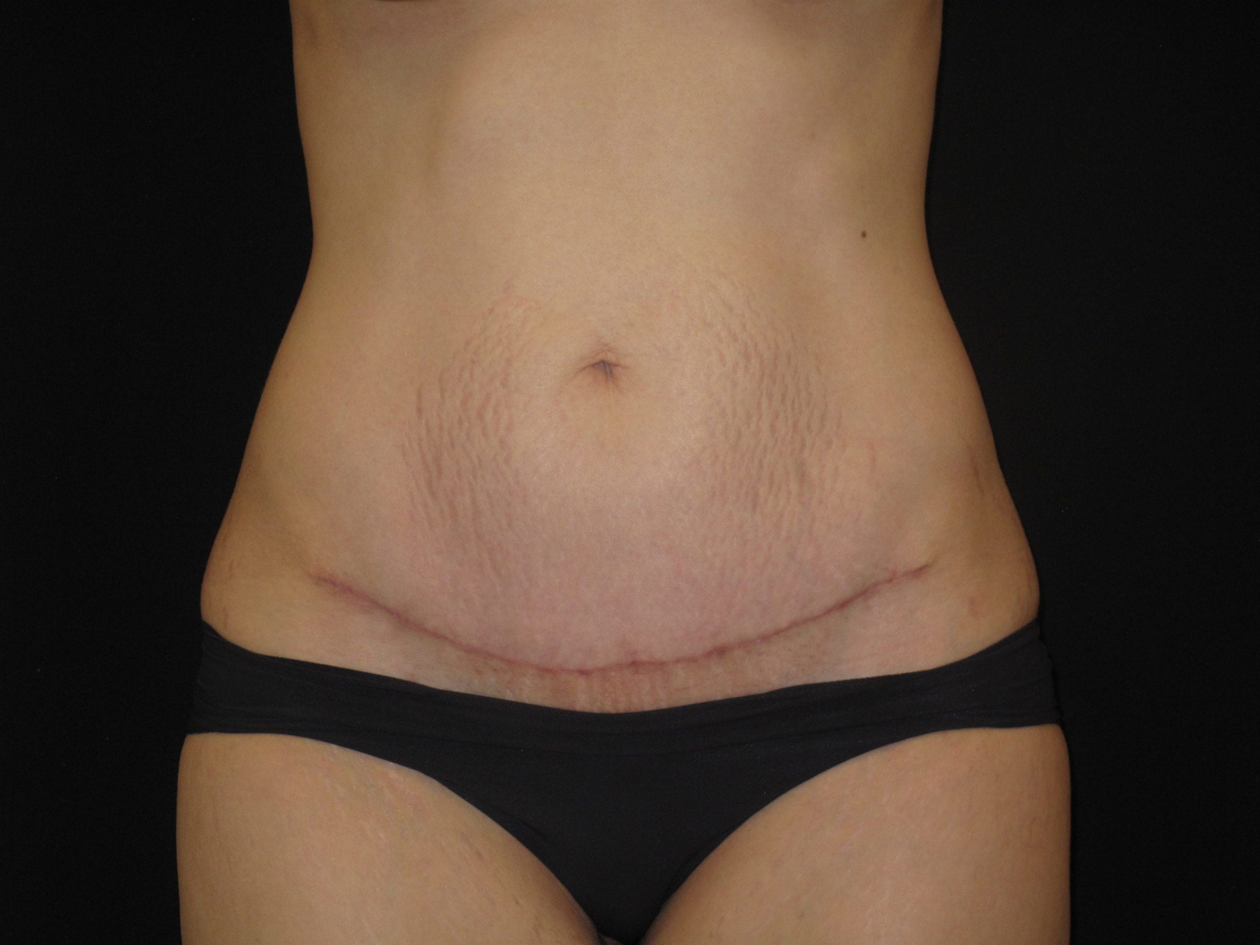 A result from Kramer Plastic Surgery