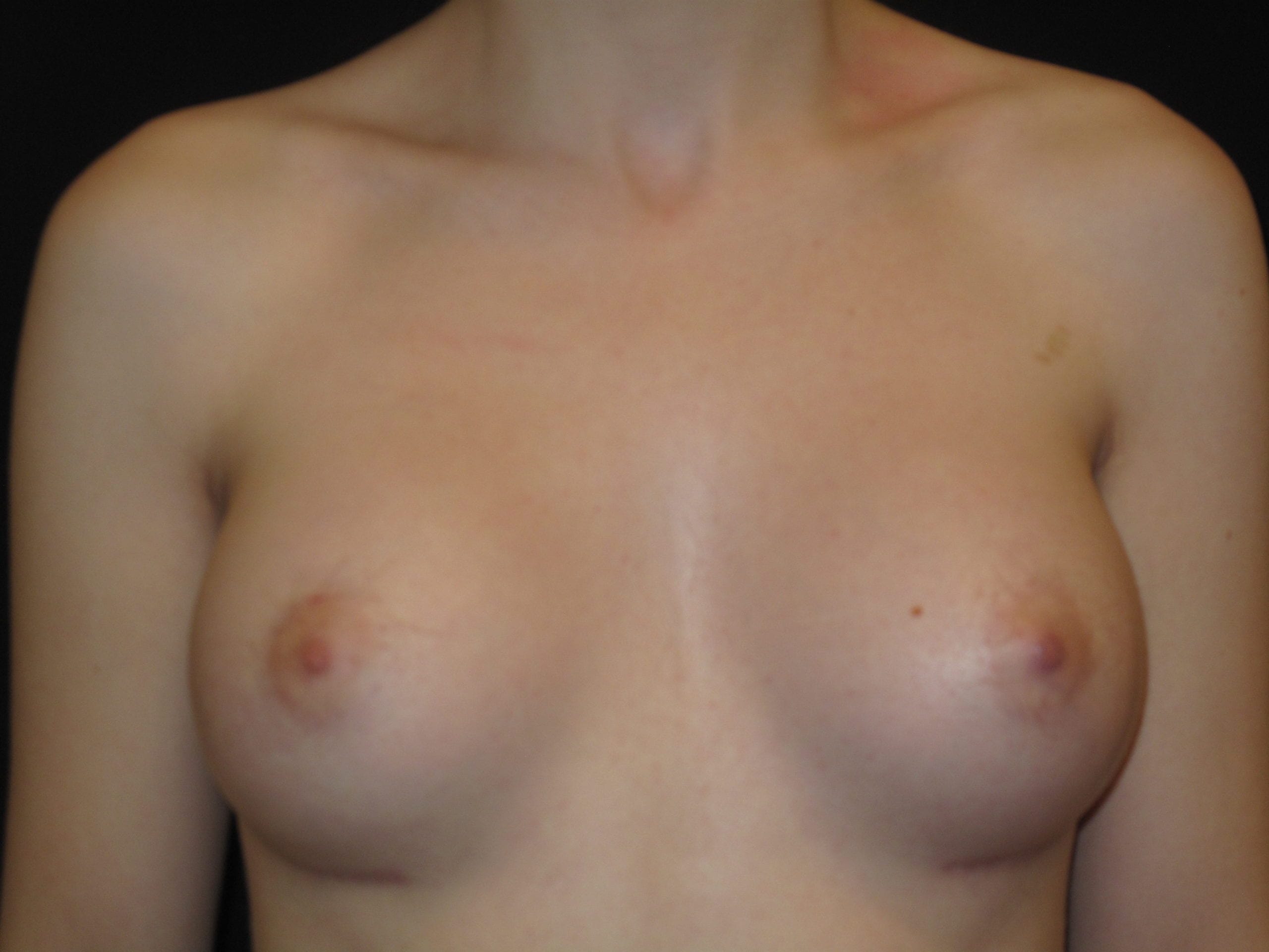 A result from Kramer Plastic Surgery