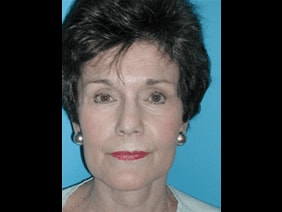 A result from Kramer Plastic Surgery